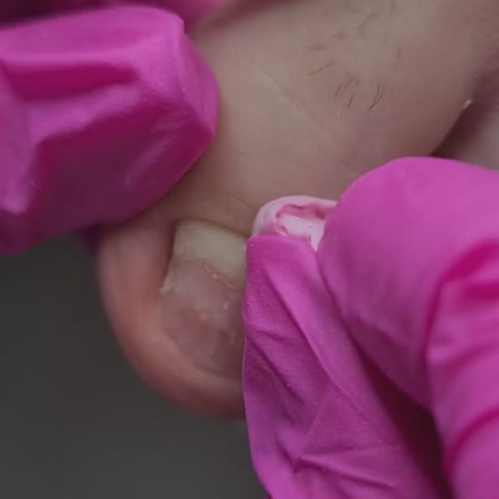 Odorless monomer – güçlü yapışma, yüksek elastisite

Medikal protez için monomer – kontrollü ısı ile sertleşme