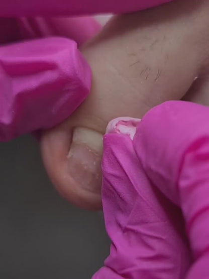 Odorless monomer – güçlü yapışma, yüksek elastisite

Medikal protez için monomer – kontrollü ısı ile sertleşme